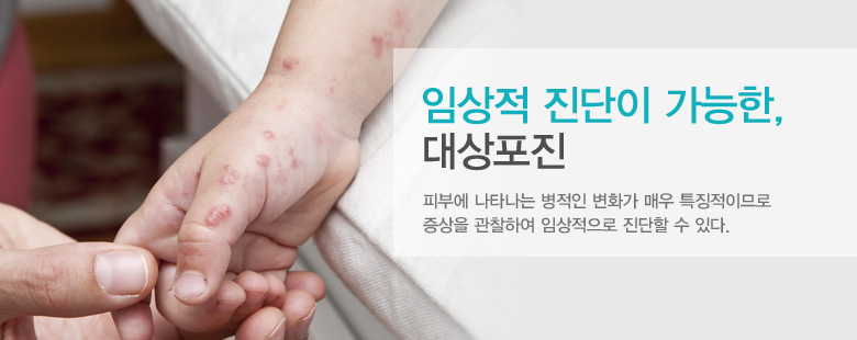임상적 진단이 가능한, 대상포진