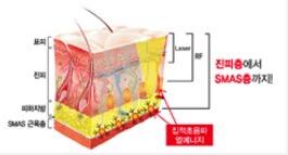 피부 단면 일러스트 &mdash; 표피&middot;진피&middot;SMAS층 위치와 더블로 레이저 조사 깊이 표시
