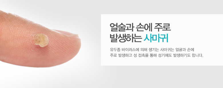 얼굴과 손에 주로 발생하는 사마귀