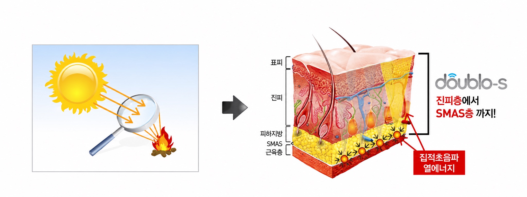 더블로-S 치료원리 설명 이미지