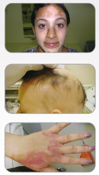 백반증&middot;원형탈모&middot;건선 치료 사례 사진 3장, 장비 전경, 치료 적용 부위 안내 브로슈어 전체