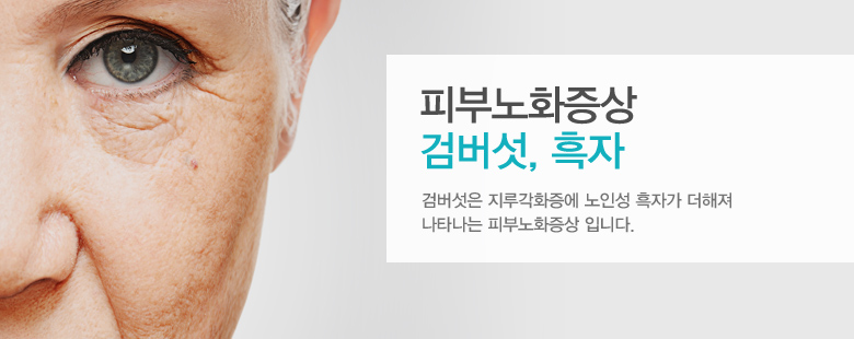 피부노화증상 검버섯, 흑자